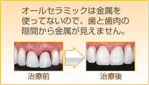 オールセラミックは金属を使っていないので、歯と歯肉の隙間から金属が見えません。オールセラミックによる白い歯実現