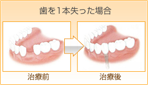 奥歯の歯を一本失った場合のインプラント治療