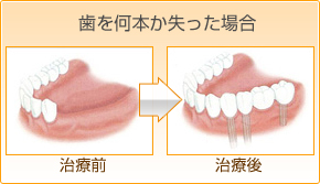 所沢の患者様で前歯と奥歯ほか歯を何本か失った場合のインプラント事例