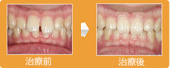 治療期間約４か月の部分矯正歯科治療の症例