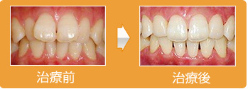 前歯が突出した症例、治療期間約１０カ月の矯正治療