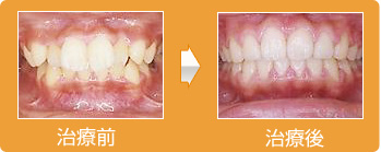 歯医者さんに相談してからの矯正歯科治療期間約１年、上下乱歯列、噛み合わせのずれ