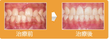 子供の歯並び治療、約２年の小児矯正期間